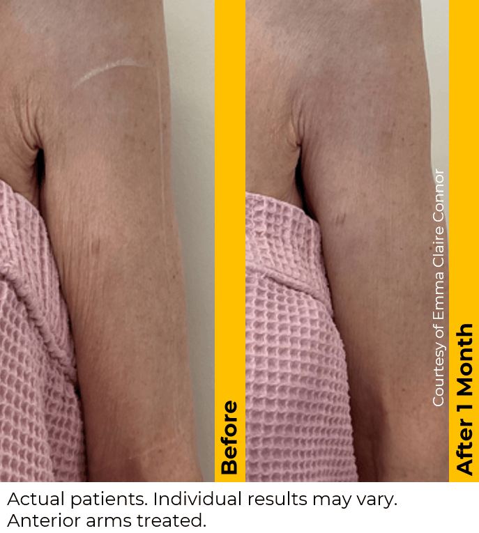 Ultherapy PRIME before and after — Anterior Arms · 1 Month