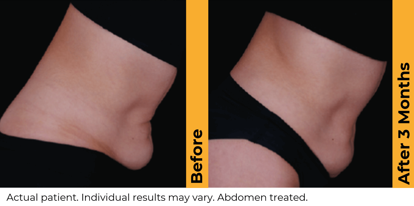 Ultherapy PRIME before and after — Abdomen · 3 Months