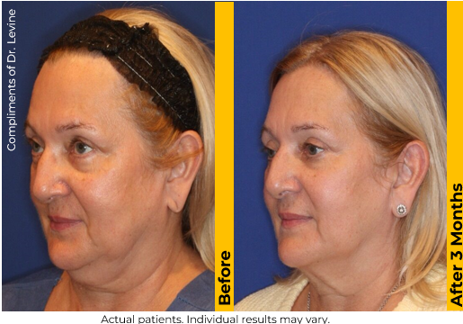 Ultherapy PRIME before and after — Face · 3 Months