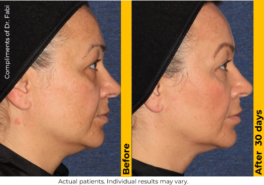 Ultherapy PRIME before and after — Face · 30 Days