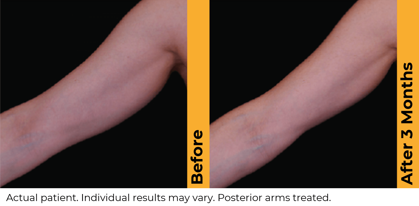 Ultherapy PRIME before and after — Posterior Arms · 3 Months