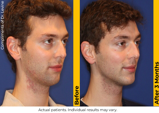 Ultherapy PRIME before and after — Jawline · 3 Months