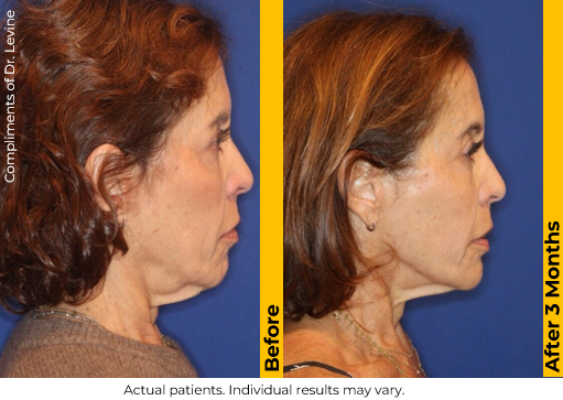 Ultherapy PRIME before and after — Neck & Jawline · 3 Months